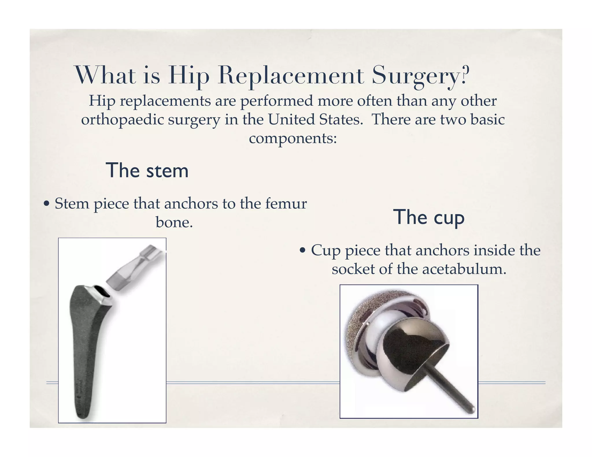 What is Hip Replacement Surgery?
      Hip replacements are performed more often than any other
     orthopaedic surgery in the United States. There are two basic
                             components: !

         The stem	

• Stem piece that anchors to the femur
                bone.!                           The cup	

                                    • Cup piece that anchors inside the
                                        socket of the acetabulum.!
 