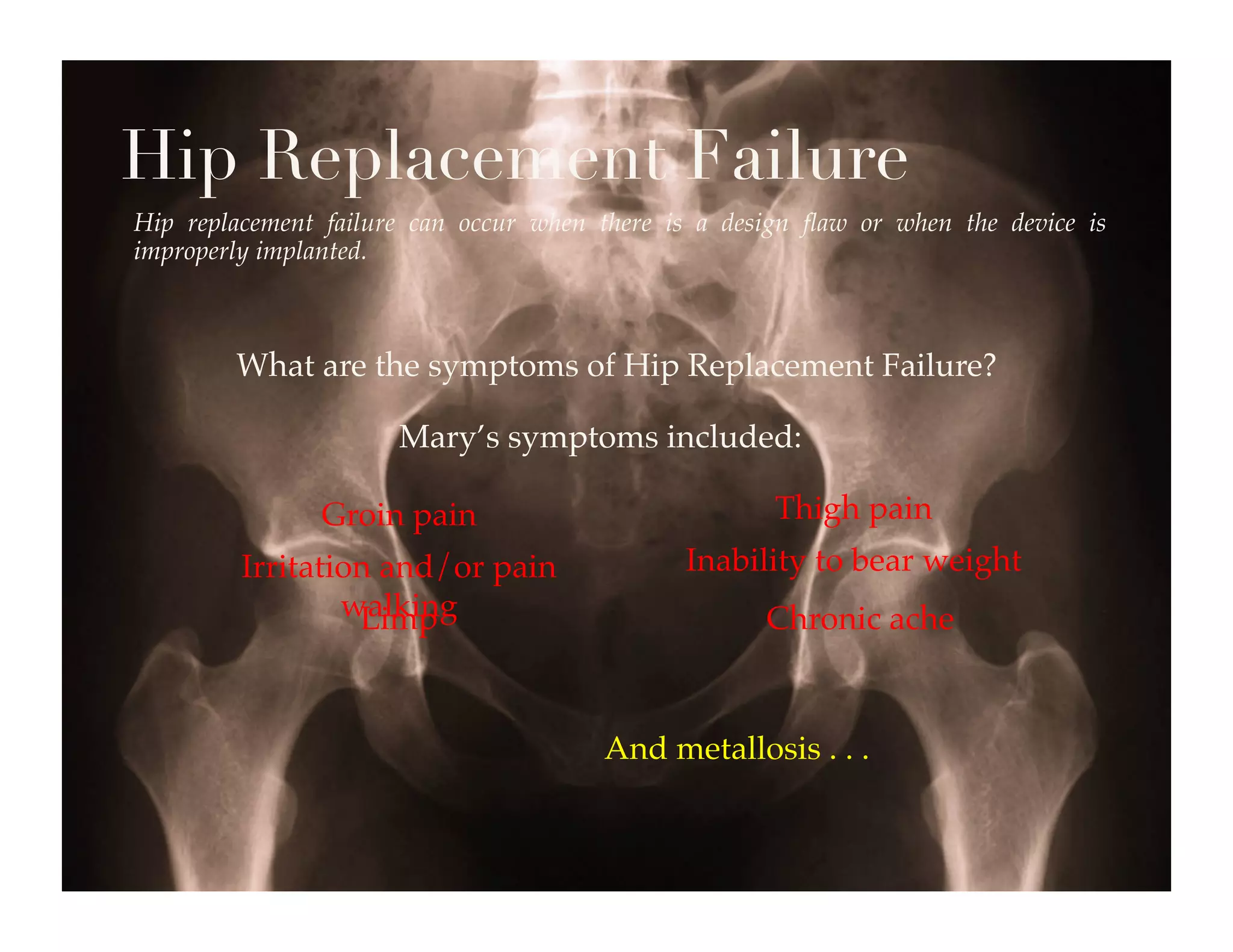 Hip Replacement Failure
Hip replacement failure can occur when there is a design ﬂaw or when the device is
improperly implanted.!



        What are the symptoms of Hip Replacement Failure?!

                      Mary’s symptoms included:!

               Groin pain!                            Thigh pain!
         Irritation and/or pain               Inability to bear weight!
                 walking!
                  Limp!                              Chronic ache!



                                       And metallosis . . .!
 