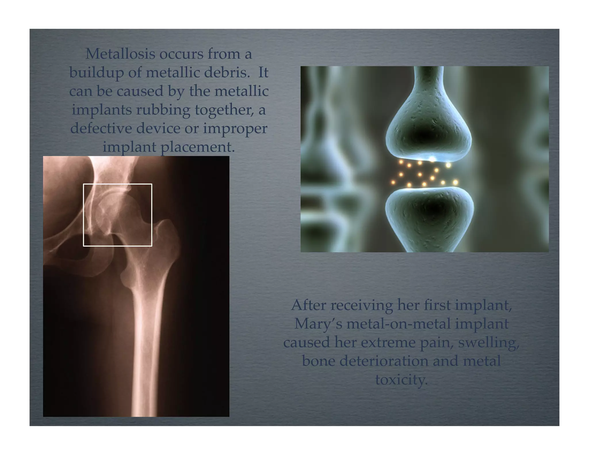 Metallosis occurs from a
buildup of metallic debris. It
can be caused by the metallic
implants rubbing together, a
defective device or improper
     implant placement.!




                                  After receiving her ﬁrst implant,
                                   Mary’s metal-on-metal implant
                                 caused her extreme pain, swelling,
                                    bone deterioration and metal
                                               toxicity.!
 