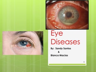 Eye
Diseases
By: Sandy Santos
&
Bianca Macias
1

 