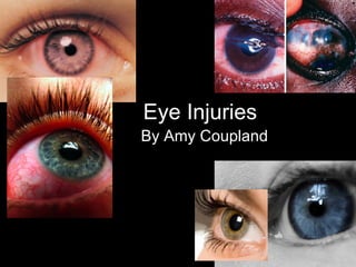 Eye Injuries   By Amy Coupland 