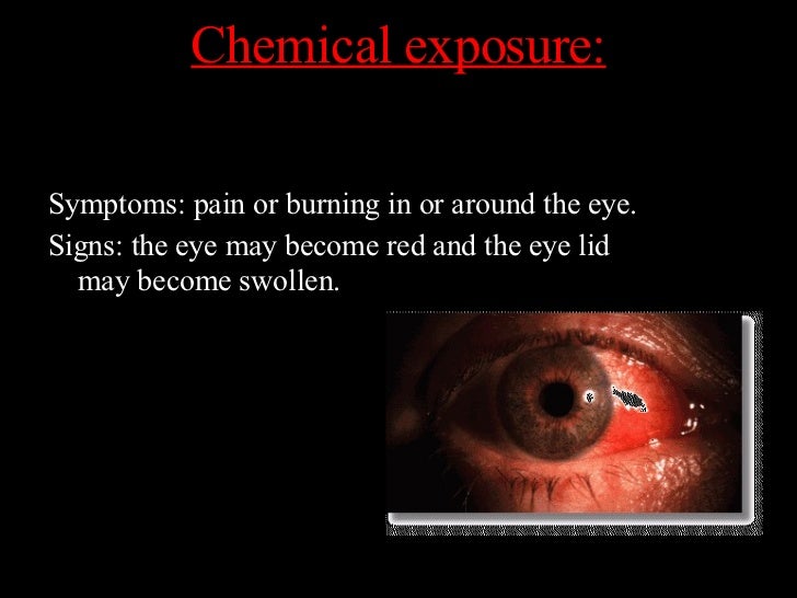 Eye Injuries