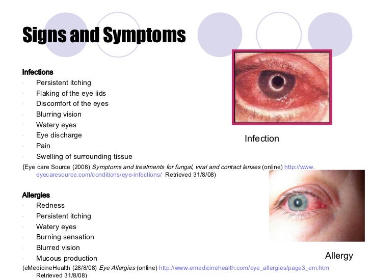Eye Injuries