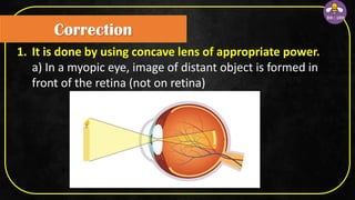 1. It is done by using concave lens of appropriate power.
a) In a myopic eye, image of distant object is formed in
front of the retina (not on retina)
Correction
 