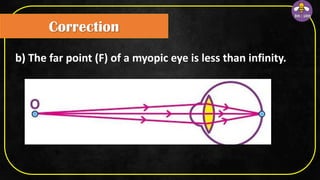 b) The far point (F) of a myopic eye is less than infinity.
Correction
 