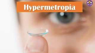 Hypermetropia
 