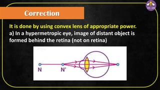Correction
It is done by using convex lens of appropriate power.
a) In a hypermetropic eye, image of distant object is
formed behind the retina (not on retina)
 