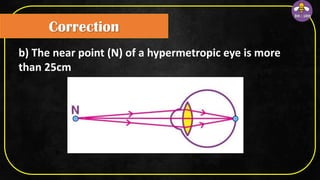 Correction
b) The near point (N) of a hypermetropic eye is more
than 25cm
 