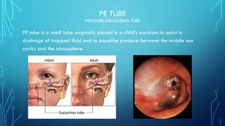 PE TUBE
PRESSURE EQUALIZING TUBE
PE tube is a small tube surgically placed in a child’s eardrum to assist in
drainage of trapped fluid and to equalize pressure between the middle ear
cavity and the atmosphere.
 