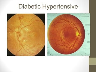 Diabetic Hypertensive
 