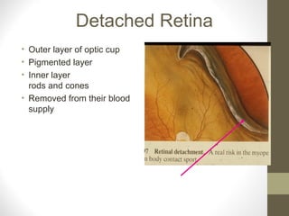 Detached Retina
• Outer layer of optic cup
• Pigmented layer
• Inner layer
rods and cones
• Removed from their blood
supply
 