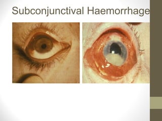 Subconjunctival Haemorrhage
 