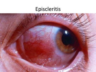 Episcleritis

 