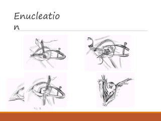 Auto Enucleation eye bank, eye donation, corneal transplantation.pdf