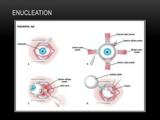 ENUCLEATION
 