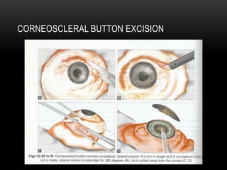 CORNEOSCLERAL BUTTON EXCISION
 