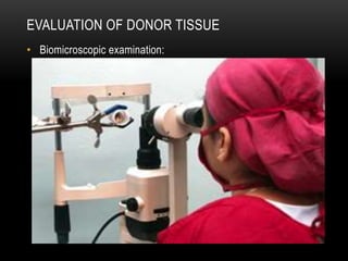 EVALUATION OF DONOR TISSUE
• Biomicroscopic examination:
 