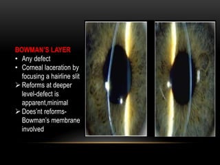 BOWMAN’S LAYER
• Any defect
• Corneal laceration by
focusing a hairline slit
Reforms at deeper
level-defect is
apparent,minimal
Does’nt reforms-
Bowman’s membrane
involved
 