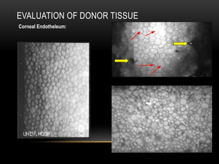 EVALUATION OF DONOR TISSUE
Corneal Endotheleum:
 