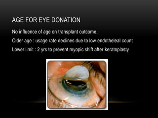 AGE FOR EYE DONATION
No influence of age on transplant outcome.
Older age : usage rate declines due to low endotheleal count
Lower limit : 2 yrs to prevent myopic shift after keratoplasty
 
