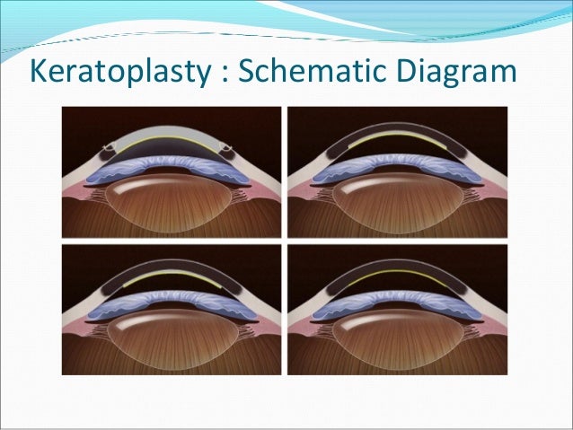 Eye banking and corneal transplantation 10.03.16,dr.k.n.jha
