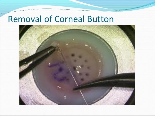 Eye banking and corneal transplantation 10.03.16,dr.k.n.jha