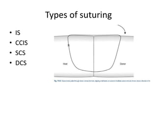 Types of suturing
• IS
• CCIS
• SCS
• DCS
 