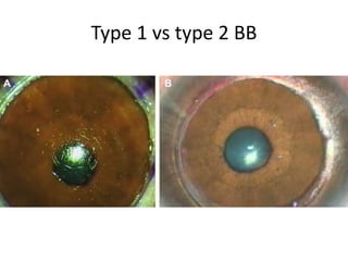 Type 1 vs type 2 BB
 