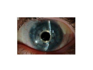 Eye banking and keratoplasty