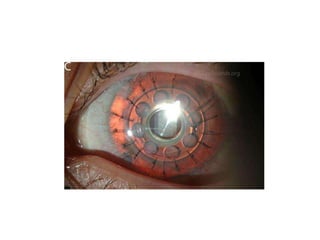 Eye banking and keratoplasty