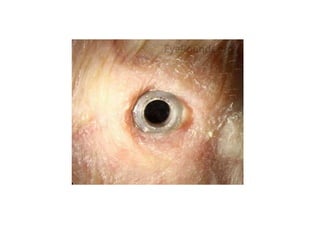 Eye banking and keratoplasty