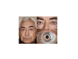 Eye banking and keratoplasty