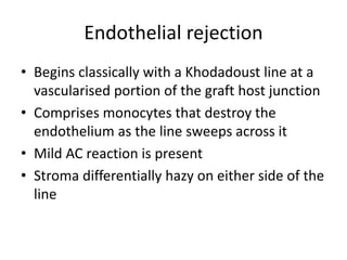 Endothelial rejection
• Begins classically with a Khodadoust line at a
vascularised portion of the graft host junction
• Comprises monocytes that destroy the
endothelium as the line sweeps across it
• Mild AC reaction is present
• Stroma differentially hazy on either side of the
line
 