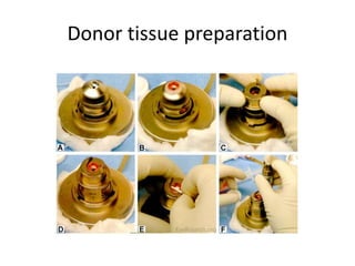 Donor tissue preparation
 