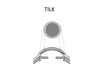 TILK
 