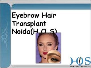 Eyebrow Hair
Transplant
Noida(H.O.S)

 