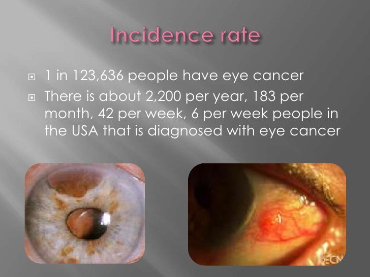 Eye Cancer