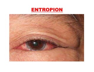 Entropo Eye disorders | PDF