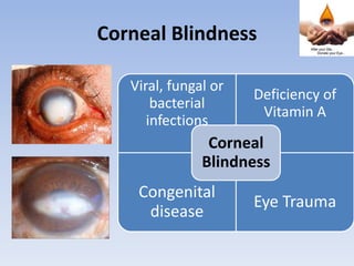 Corneal Blindness
Viral, fungal or
bacterial
infections
Deficiency of
Vitamin A
Congenital
disease
Eye Trauma
Corneal
Blindness
 