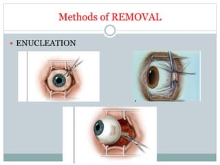 Enucleating Eye donation | PPTX