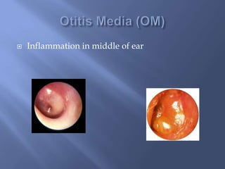  Inflammation in middle of ear