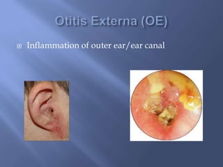 Inflammation of outer ear/ear canal