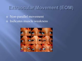  Non-parallel movement
Indicates muscle weakness