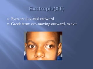  Eyes are deviated outward
Greek term: exo-moving outward, to exit