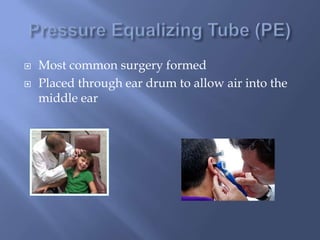  Most common surgery formed
Placed through ear drum to allow air into the
middle ear