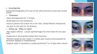  Investigation
Computed tomography (CT) scan of the orbits and brain (axial and coronal
views).
 Treatment
-Nasal decongestants for 7-10 days.
-Broad spectrum oral antibiotics.
-Instruct patient not to blow his or her nose. (Avoid Valsalva manoeuvre).
-Ice pack to the orbit for 24-48 hours.
 Follow up - When to refer?
-Non-urgent referral – contact ophthalmogist for time frame for all cases
with:
-Suspected or documented orbital floor fractures.
-Patients should be seen within 1-2 weeks post trauma and evaluated for
persistent diplopia or enophthalmos.
-Surgical repair if necessary is usually performed 7 to 14 days after trauma.
 