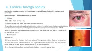 4. Corneal foreign bodies
Any foreign body penetration of the cornea or retained foreign body will require urgent
referral to
ophthalmologist - immediate consult by phone.
 History
-What is the likely foreign body?
-Examples include dirt, glass, metal and inorganic material.
-Retained organic material may lead to infection; retained metallic foreign bodies may lead to the
formation of rust rings that produce persistent inflammation and corneal epithelial defect.
-Velocity of impact? High speed motor drilling without eye protection may lead to a penetrating
corneal/scleral injury.
 Examination
-Visual acuity
-Slit lamp - assess for the size, site/s and nature of foreign body and the depth of penetration.
-Examine the cornea, anterior chamber, iris, pupil and lens for any distortion that may indicate
ocular penetration and require urgent referral to an ophthalmologist.
-Evert the eyelids to exclude retained foreign bodies – remove if appropriate.
 