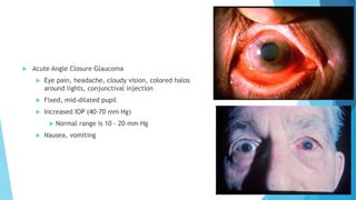  Acute Angle Closure Glaucoma
 Eye pain, headache, cloudy vision, colored halos
around lights, conjunctival injection
 Fixed, mid-dilated pupil
 Increased IOP (40-70 mm Hg)
 Normal range is 10 – 20 mm Hg
 Nausea, vomiting
 