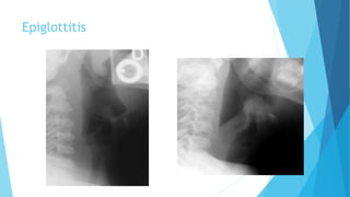 Epiglottitis
 