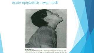 Acute epiglottitis: swan neck
 